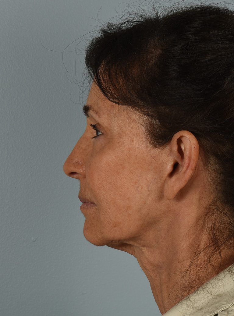 Facelift Patient Photo - Case 8328 - before view-2