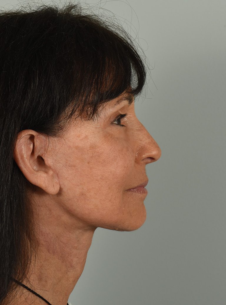 Facelift Patient Photo - Case 8328 - after view-4