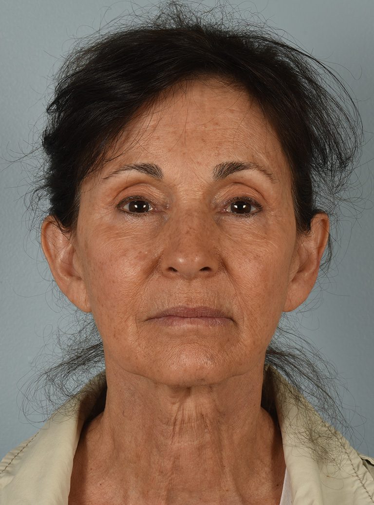 Facelift Patient Photo - Case 8328 - before view-