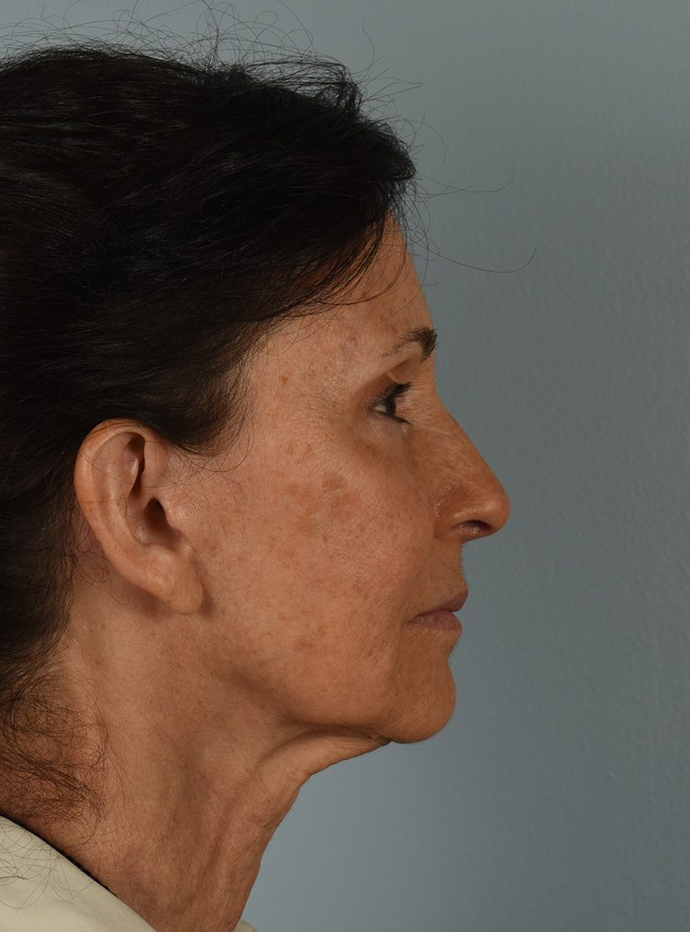 Facelift Patient Photo - Case 8328 - before view-4