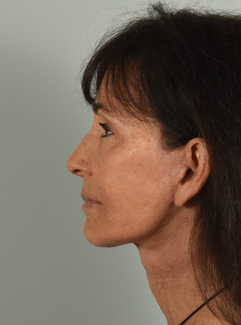 Facelift Patient Photo - Case 8328 - after view-2