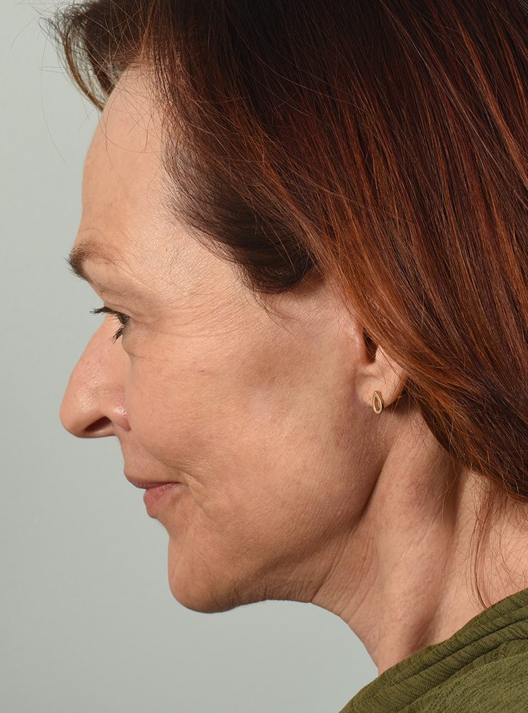 Facelift Patient Photo - Case 8382 - after view-2