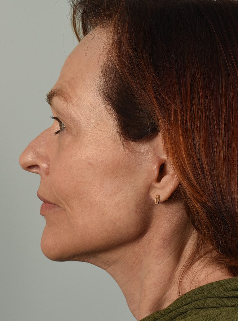 Facelift Patient Photo - Case 8382 - after view-3