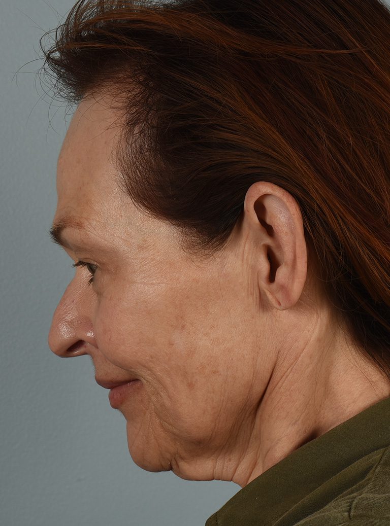 Facelift Patient Photo - Case 8382 - before view-2