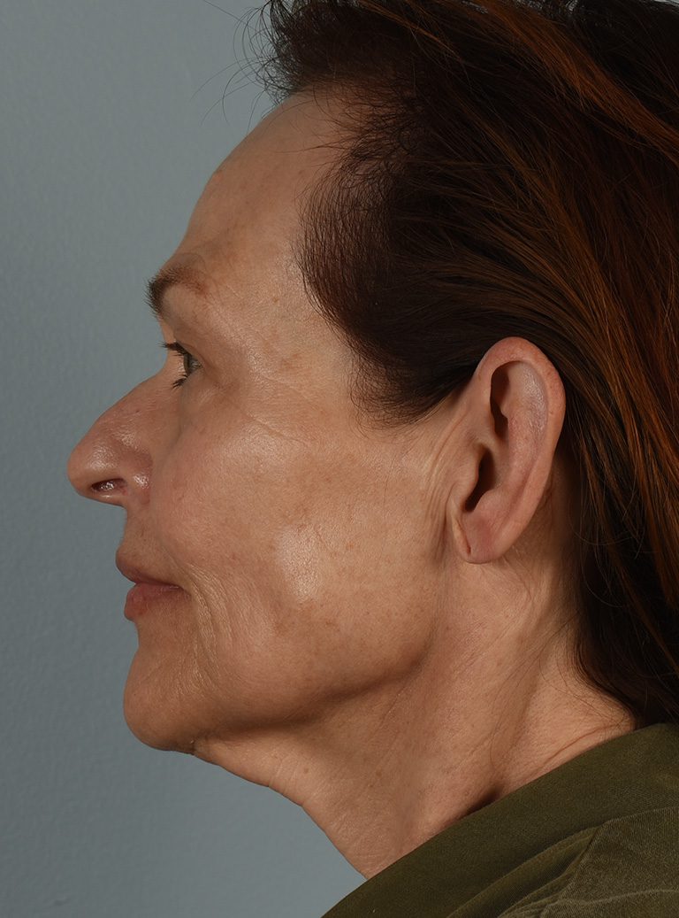 Facelift Patient Photo - Case 8382 - before view-3