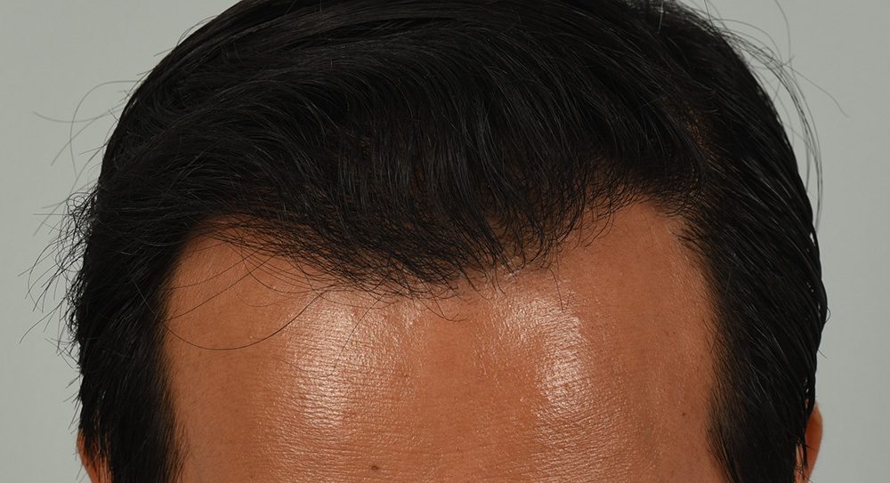 Hair Restoration Patient Photo - Case 8392 - after view