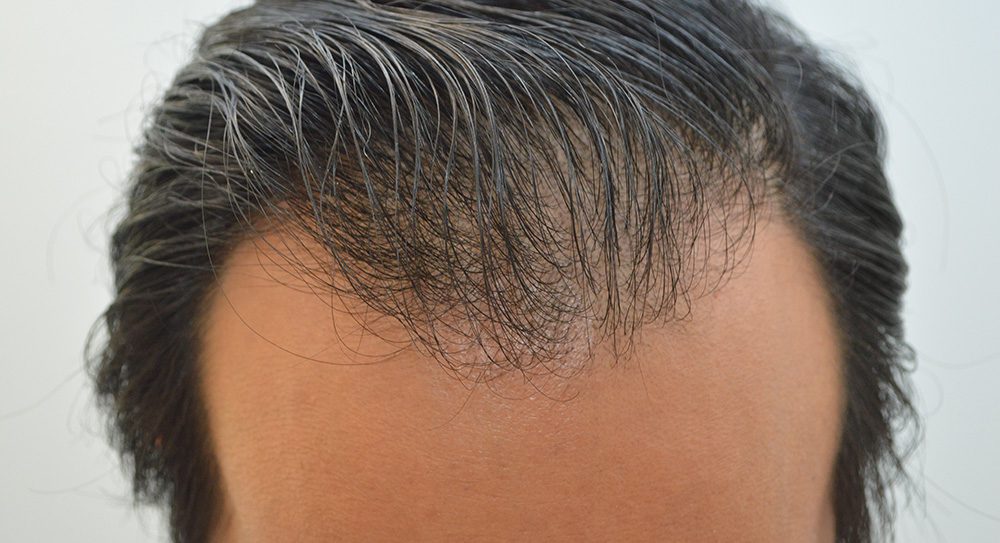 Before Hair Restoration San Clemente Orange County