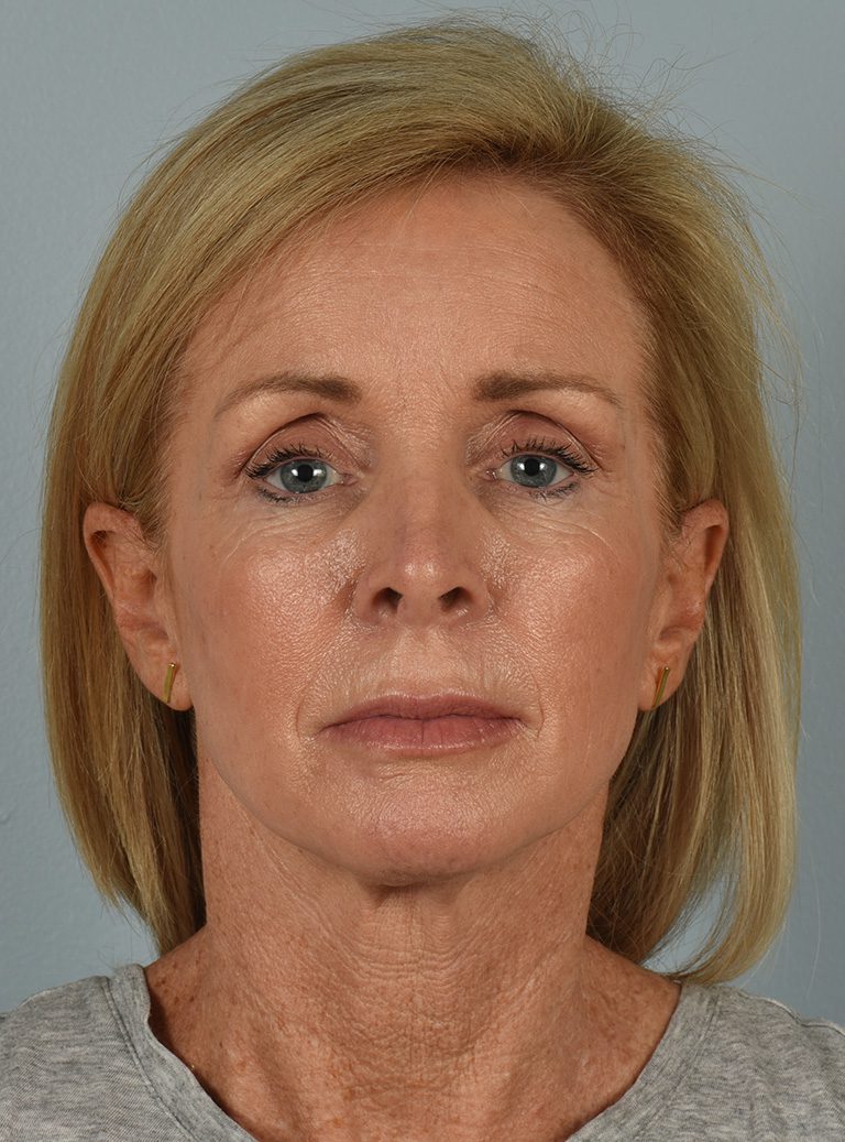 Facelift - Case 8587 - Before