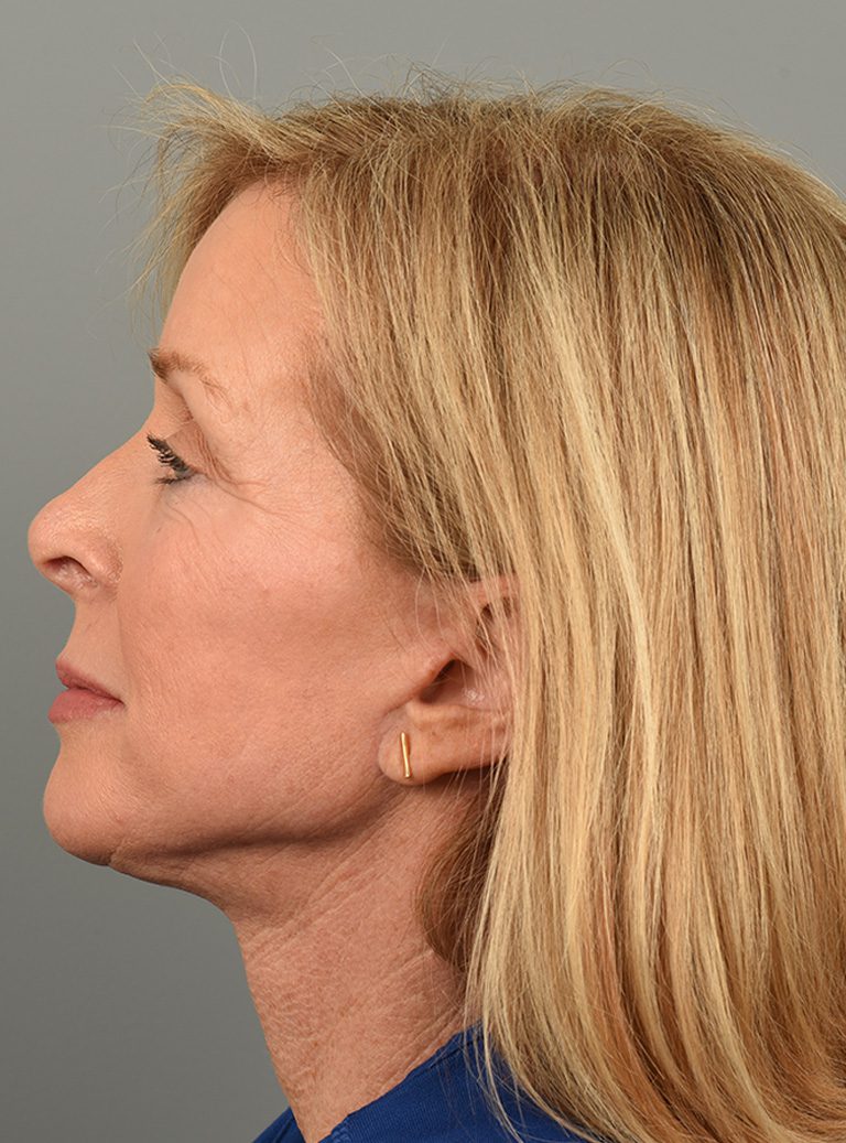 Facelift Patient Photo - Case 8587 - after view-4