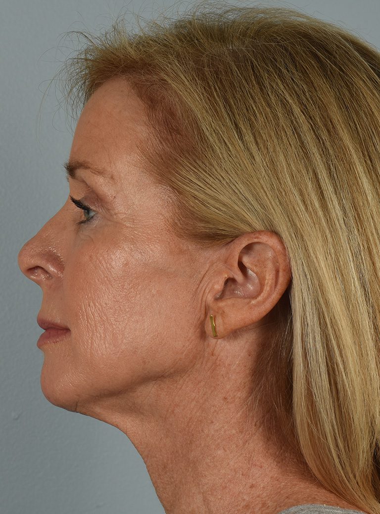 Facelift Patient Photo - Case 8587 - before view-4