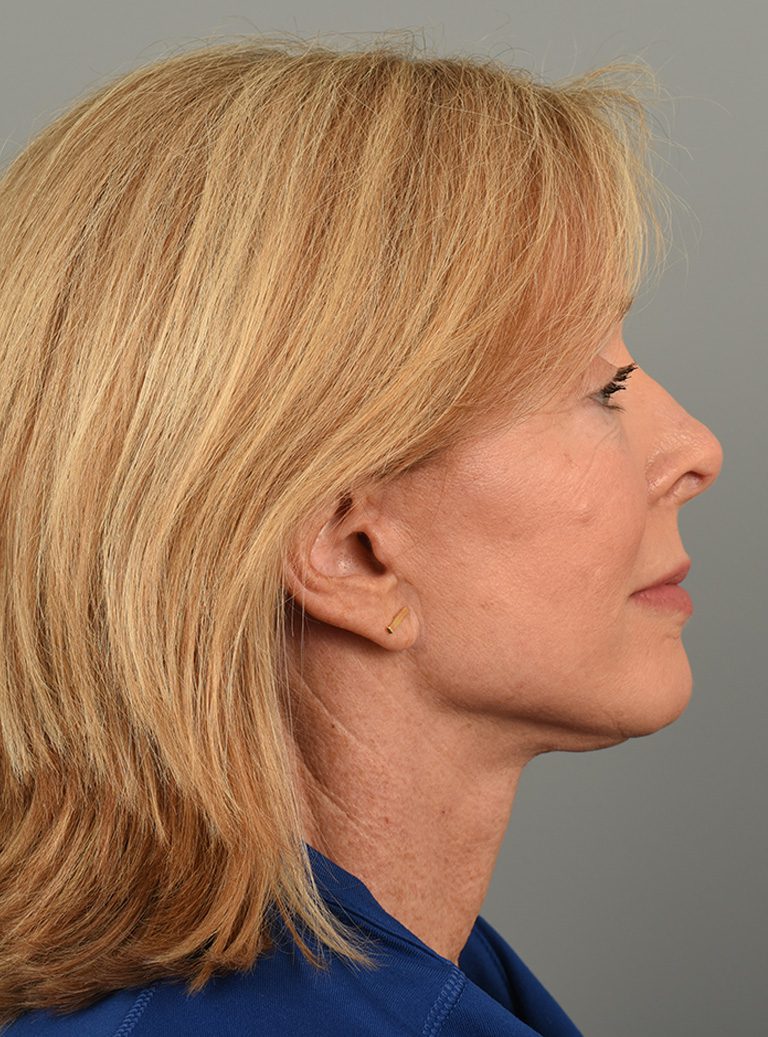 Facelift Patient Photo - Case 8587 - after view-2