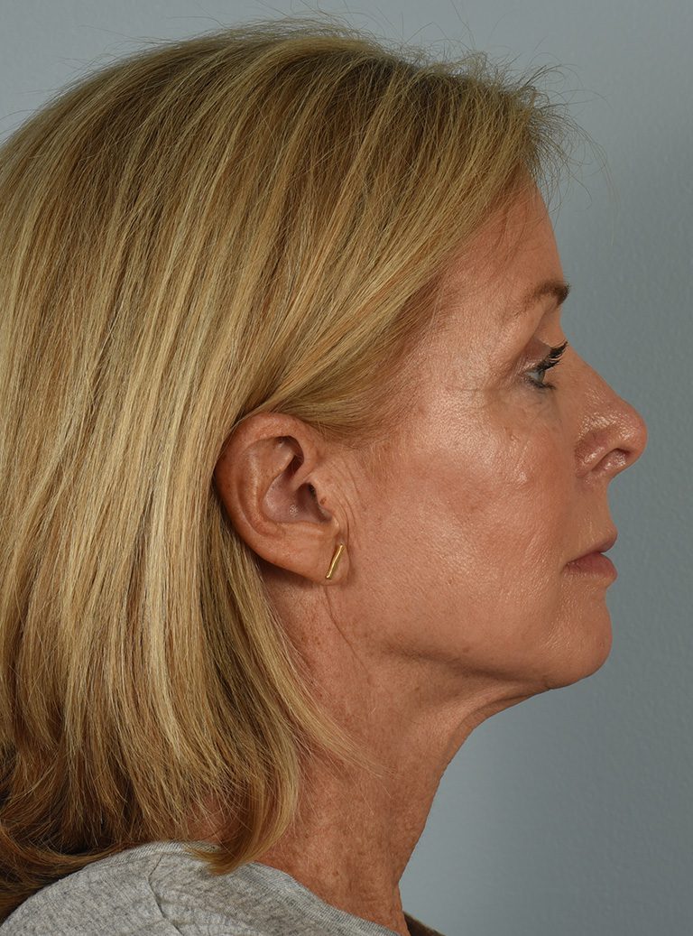 Facelift Patient Photo - Case 8587 - before view-2