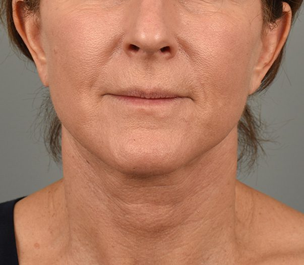 Facelift Patient Photo - Case 8599 - after view