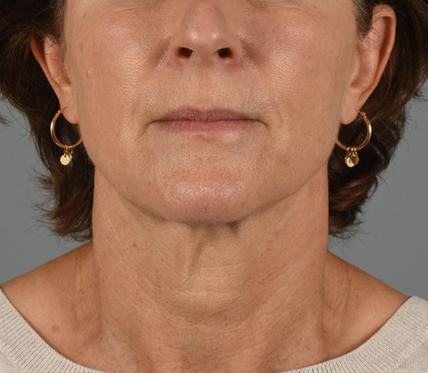 Facelift Patient Photo - Case 8599 - before view-