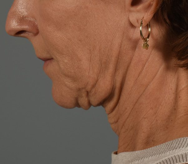 Facelift Patient Photo - Case 8599 - before view-2