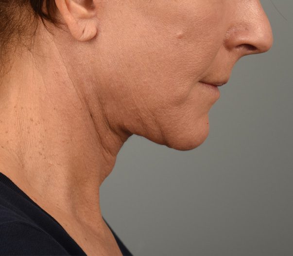 Facelift Patient Photo - Case 8599 - after view-4