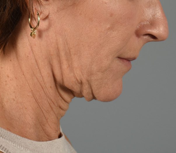 Facelift Patient Photo - Case 8599 - before view-4