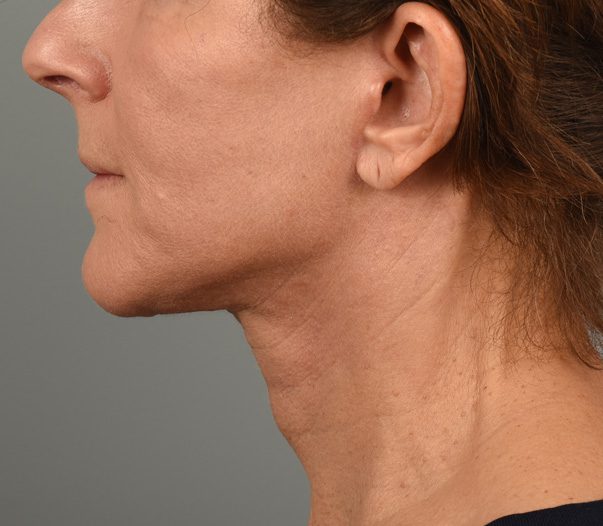 Facelift Patient Photo - Case 8599 - after view-3