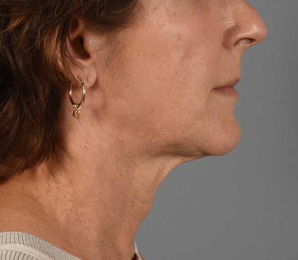 Facelift Patient Photo - Case 8599 - before view-5