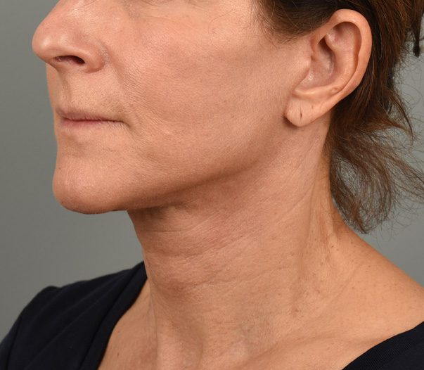 Facelift Patient Photo - Case 8599 - after view-1