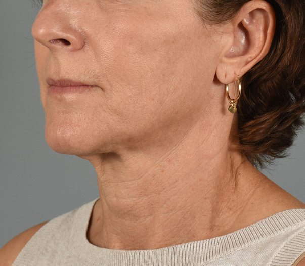 Facelift Patient Photo - Case 8599 - before view-1