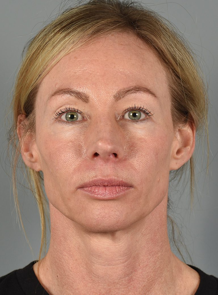 Upper Eyelid Lift - Case 8628 - Before