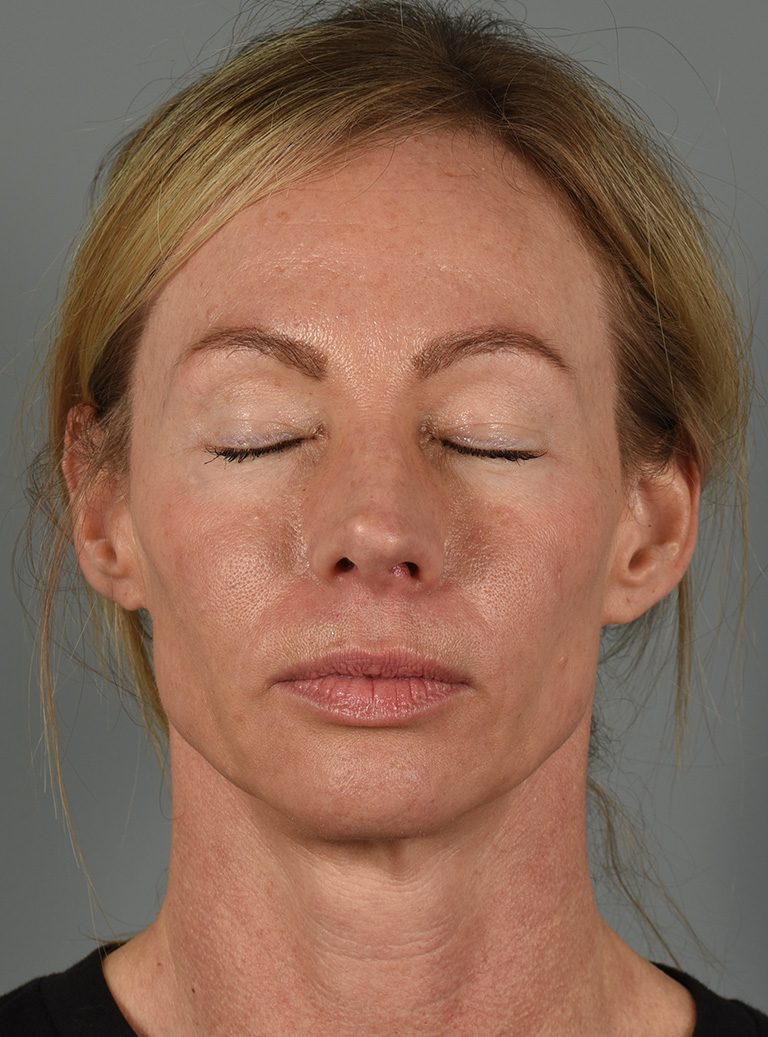 Upper Eyelid Lift Patient Photo - Case 8628 - before view-5