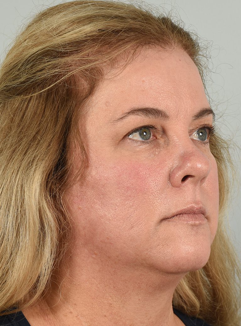 Fractional CO2 Laser Patient Photo - Case 8641 - before view-1