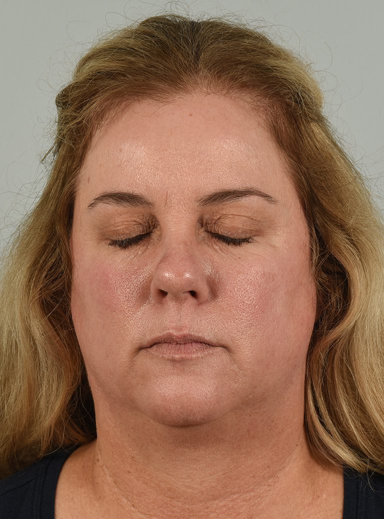 Fractional CO2 Laser Patient Photo - Case 8641 - before view-5