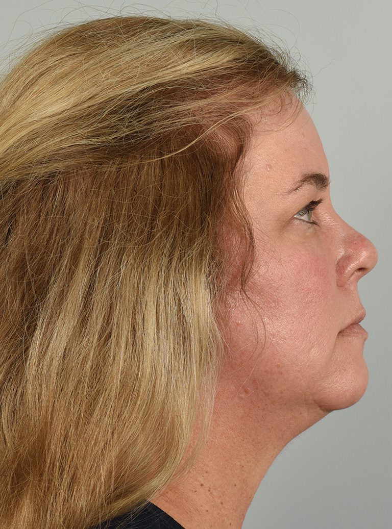 Fractional CO2 Laser Patient Photo - Case 8641 - before view-2