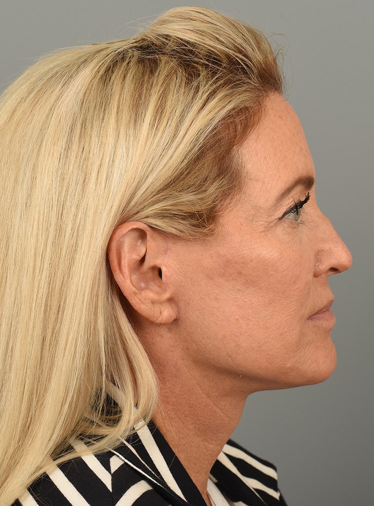 Facelift Patient Photo - Case 8667 - after view-2