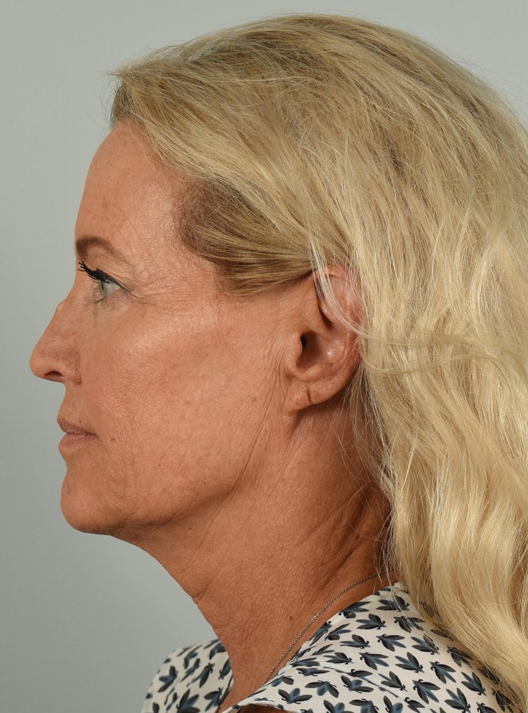 Facelift Patient Photo - Case 8667 - before view-4