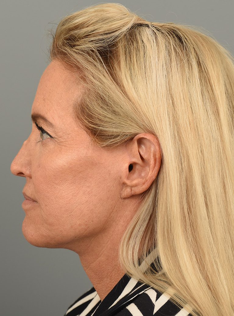 Facelift Patient Photo - Case 8667 - after view-4