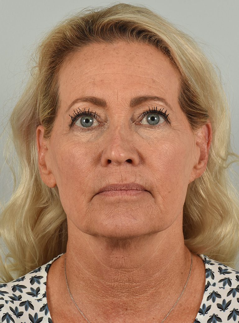 Facelift - Case 8667 - Before