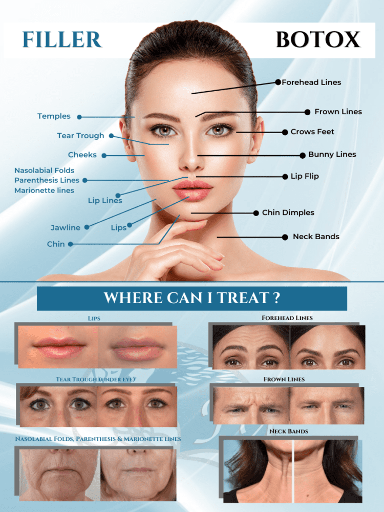 Botox and Filler areas to treat